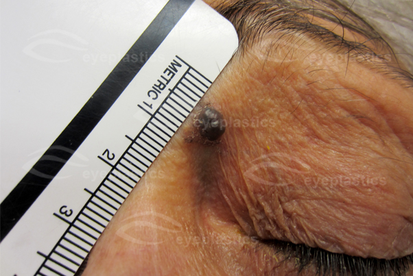 Basal Cell Carcinoma Image 3120